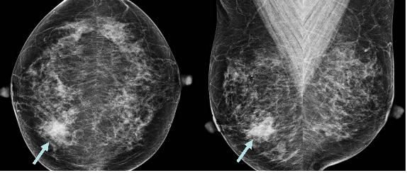 如何正確選擇乳癌篩檢工具