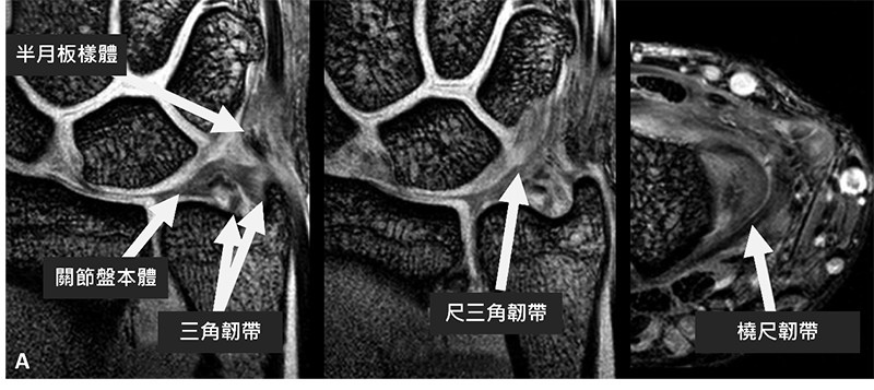手腕三角纖維軟骨於磁振造影檢查的影像評估