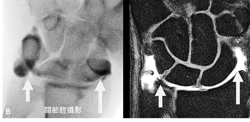 手腕三角纖維軟骨於磁振造影檢查的影像評估