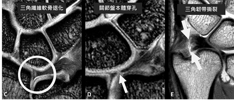 手腕三角纖維軟骨於磁振造影檢查的影像評估